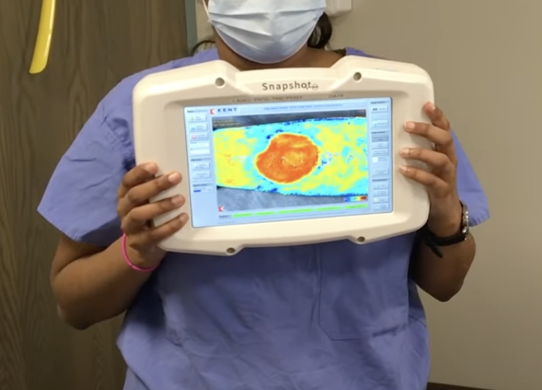 Applying Kerecis Graft to Wound, Tracking with SnapshotNIR — Kent